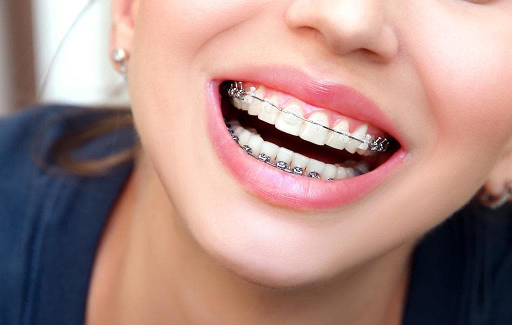 Consiga una sonrisa perfecta con ortodoncia en Narón