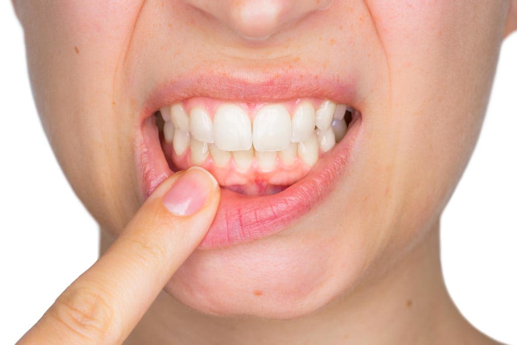 Tratamientos de periodoncia en Narón