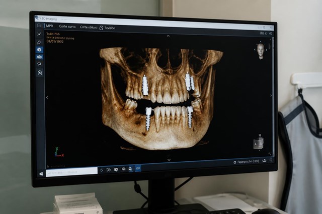 TAC dental CBCT y radiología 3D para implantes en Narón - Imagen 1